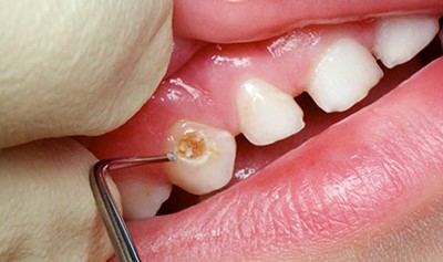 Кариес молочных зубов